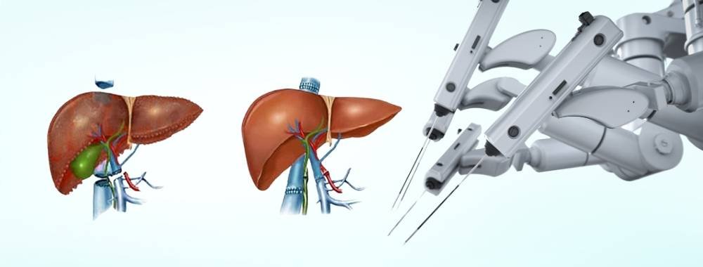 technology used in india for liver transplant surgery
