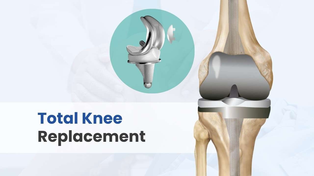 total knee replacement cost in india